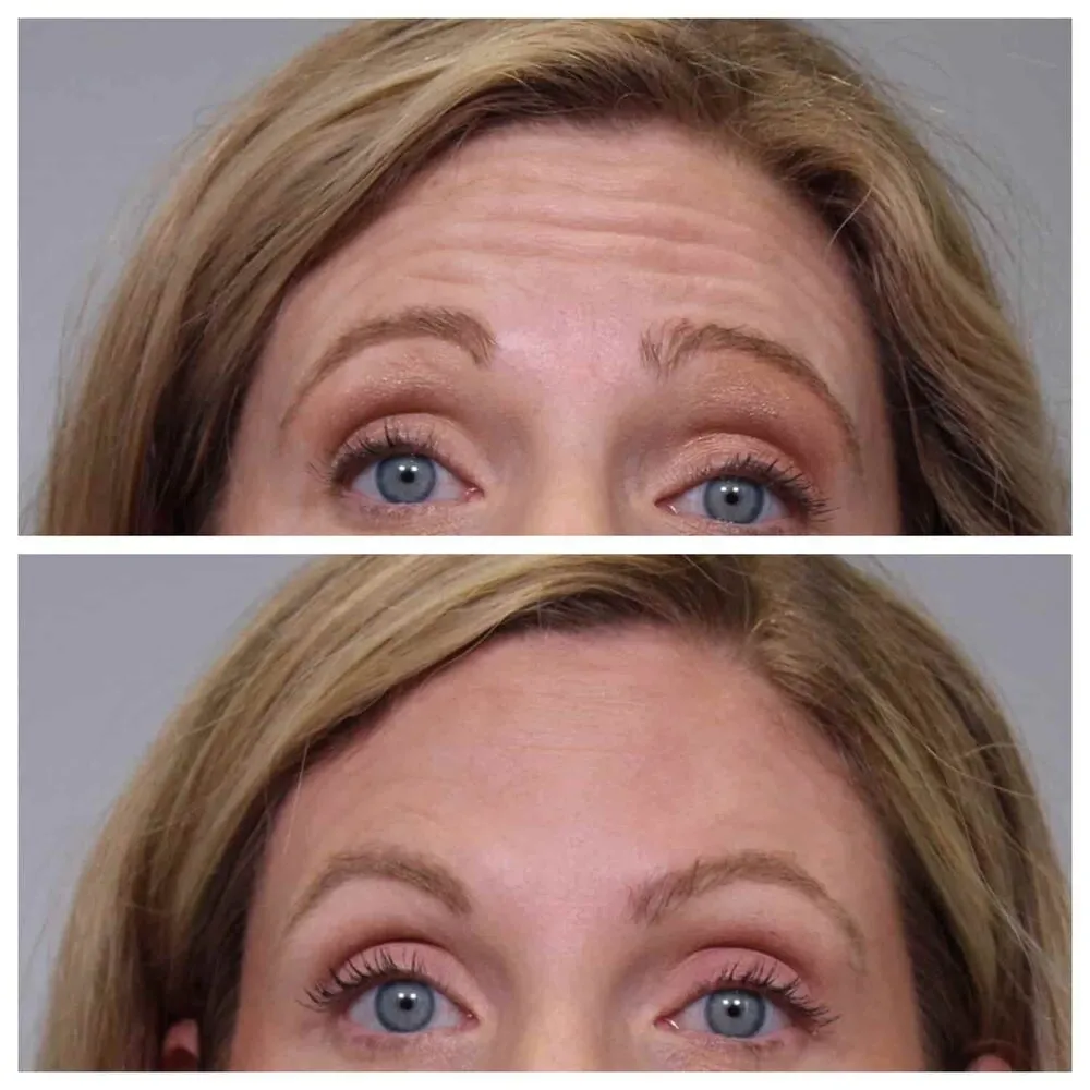 Forehead wrinkle treatment area