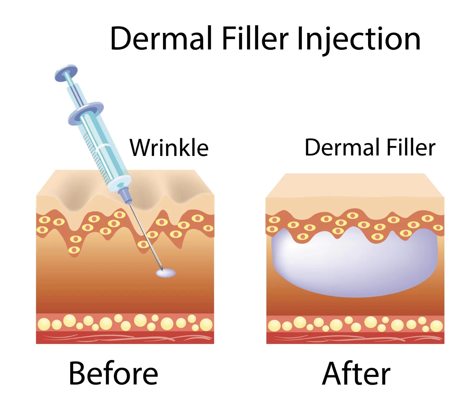 Dermal filler injection
