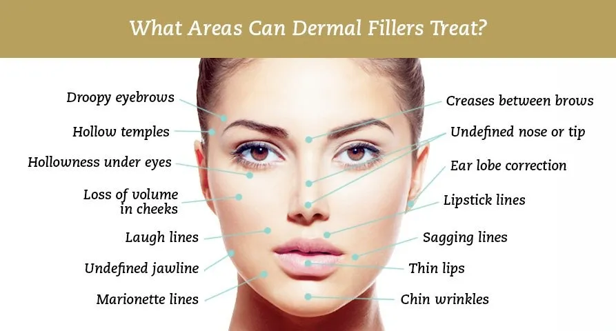 Diagram of the facial areas dermal fillers can treat