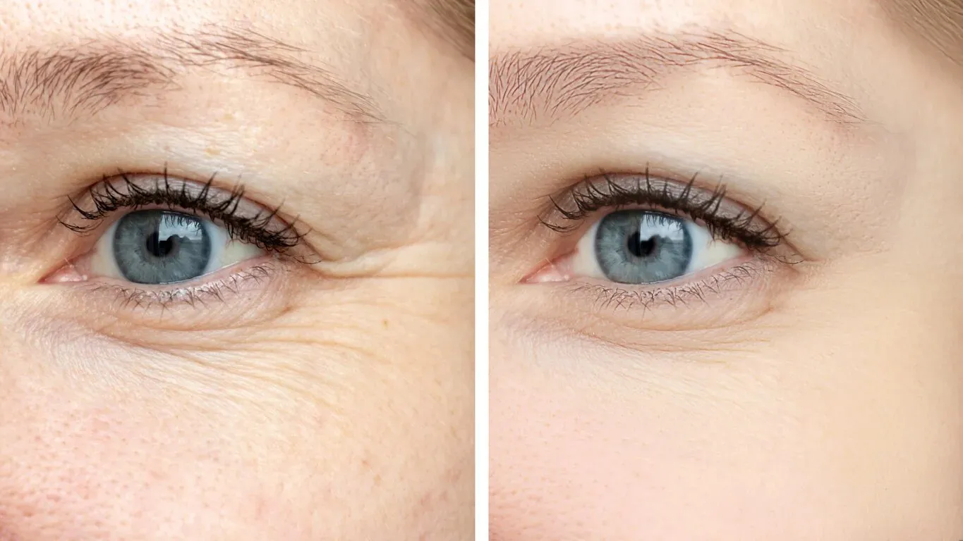 Fine lines under the eyes