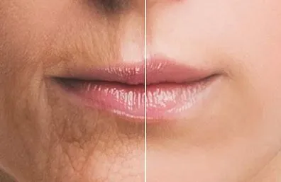 Lip fillers