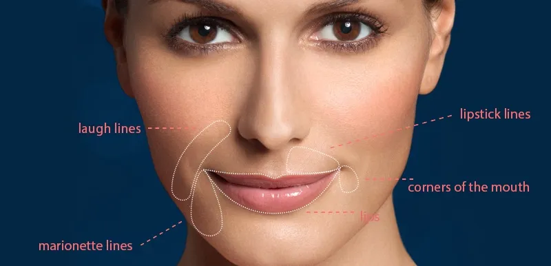 Subtle lip enhancement