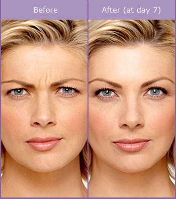 Botox Before & After Photo | Hargreaves Street Medical Practice